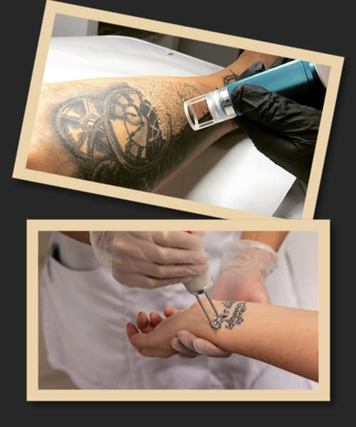 Переваги лазерного способу видалення тату
