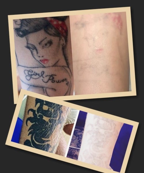 Виведення тату ремувером