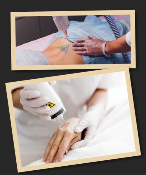 Від чого залежить швидкість видалення тату