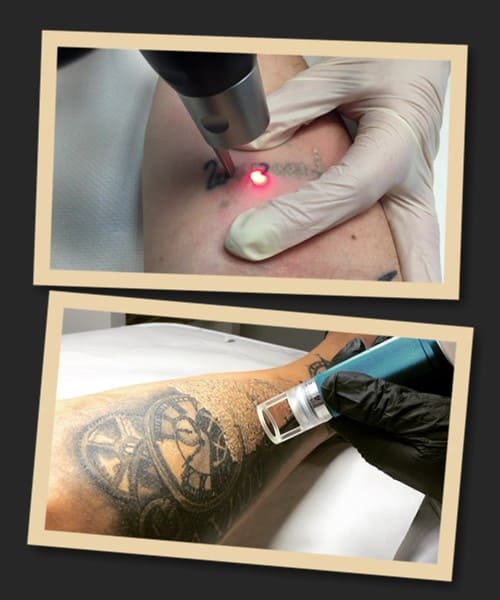 видалення тату