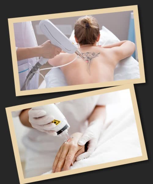 татуювання видаляється лазером