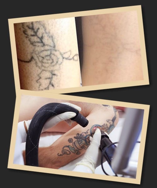 Вивод тату лазером