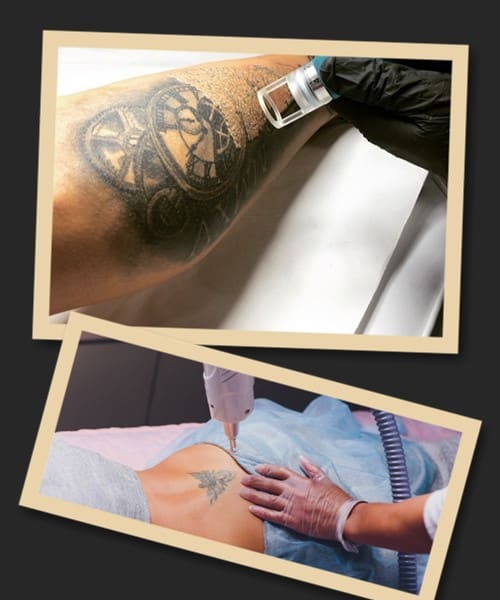 видалення перманентного малюнка лазером