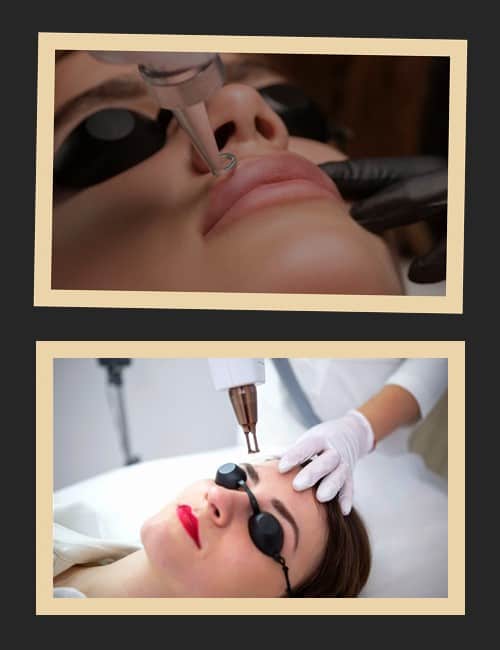 Процедура вилучення татуажу