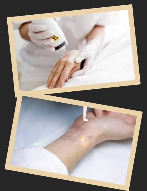 Чому лазерне видалення тату є найефективнішим