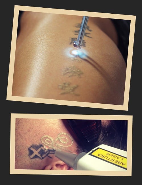 Плюси та мінуси лазерного виведення тату