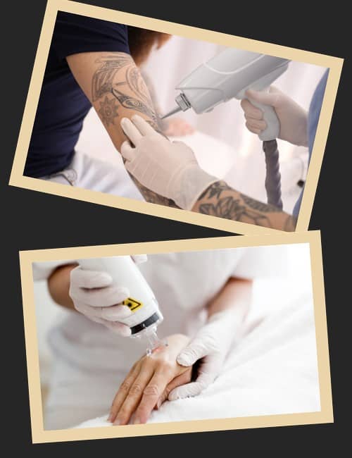 Від чого залежить вартість лазерного видалення