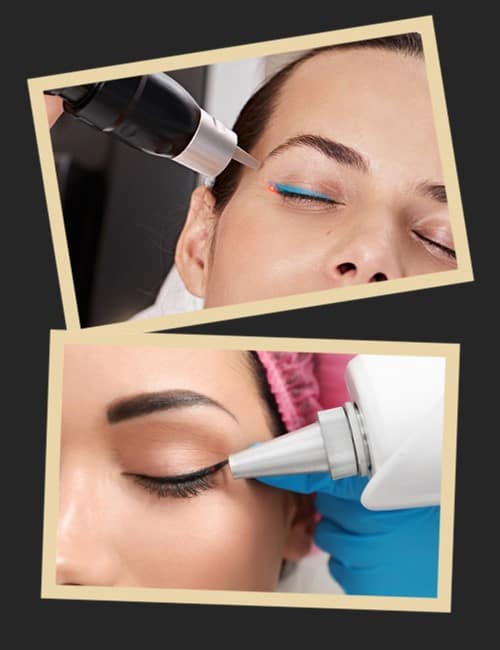 Як видаляється татуаж лазером