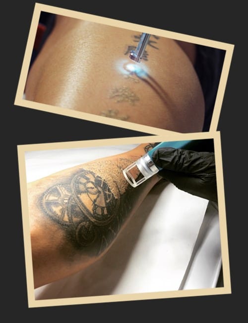 лазер татуювання видаляє дбайливо та делікатно