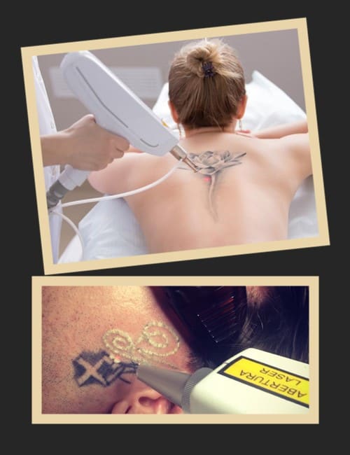 вартість видалення татуювання лазером