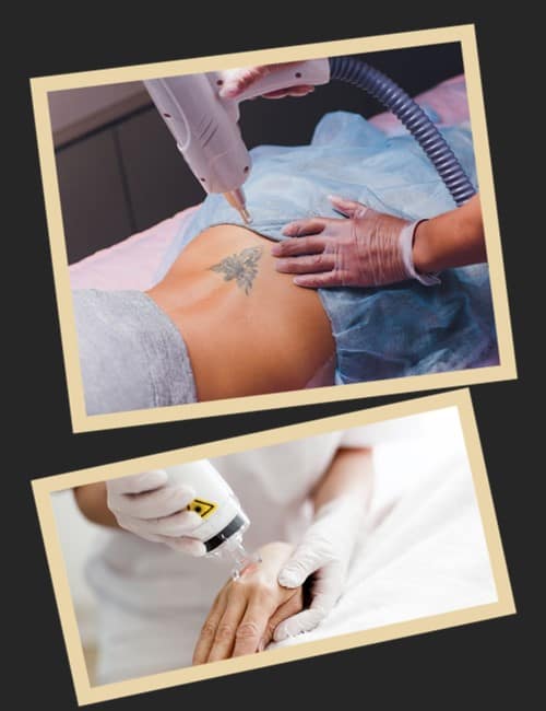 стоимость сведения тату