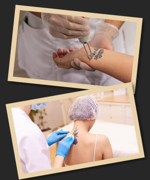 Плюси та мінуси лазерної процедури видалення тату