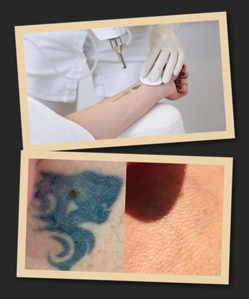 вивести татуювання ціна лазерної процедури в Києві