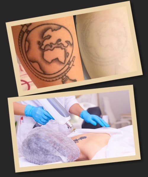 Як відбувається процедура видалення тату