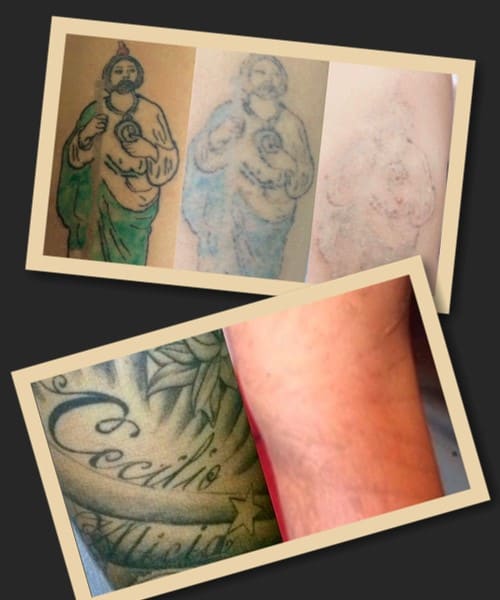 способи звести тату