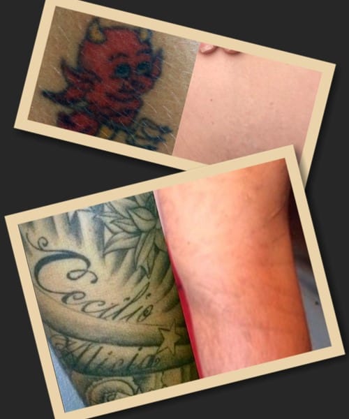 Хірургічний метод видалення тату