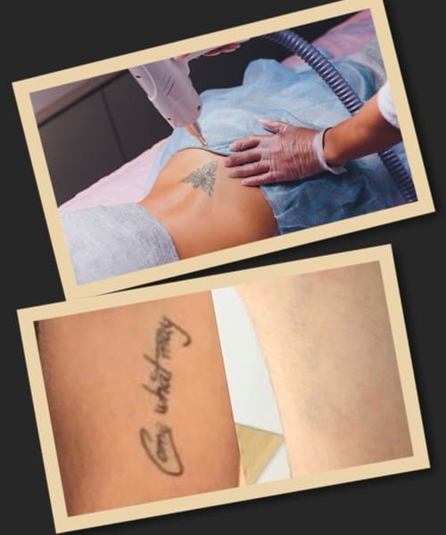 як видалити тату