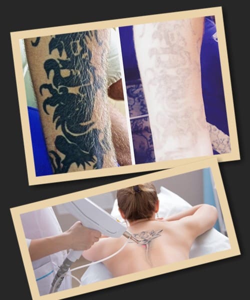 Видалення тату лазерним методом