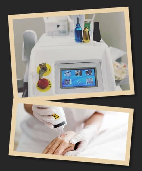 Видалення тату лазером