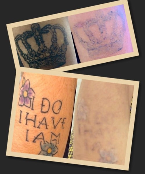 Ремувер підходить для виведення татуювань