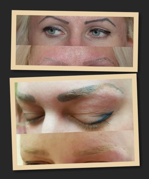 видалення татуажу