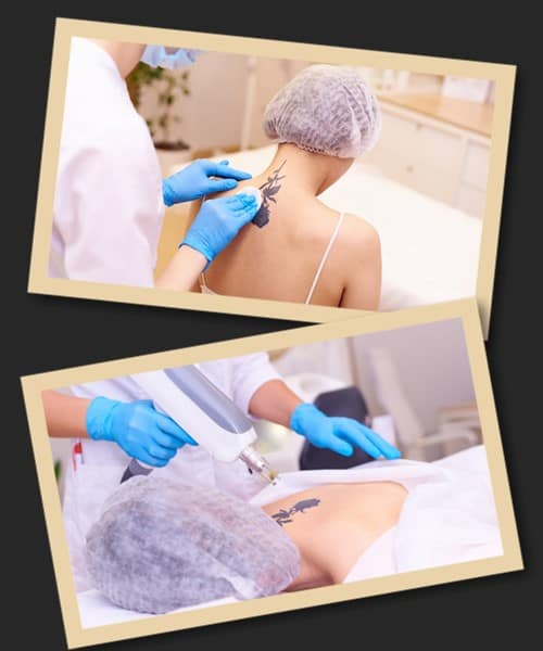 видаляти татуювання