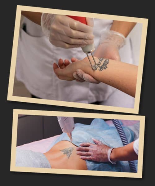 неодимовий лазер Q-switch