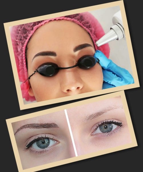 видалення татуажу