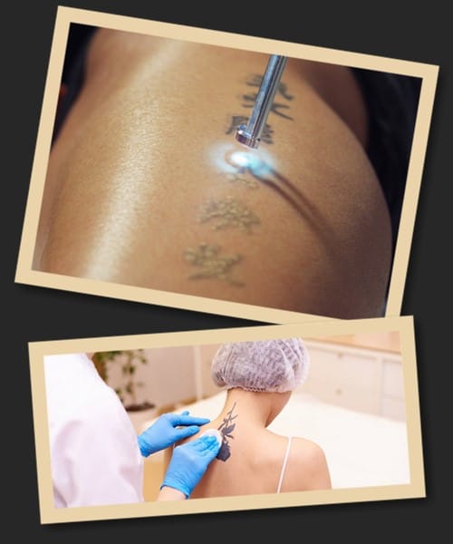 вартість виведення тату