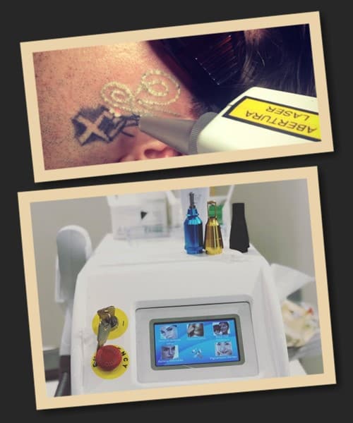 видалення татуювань