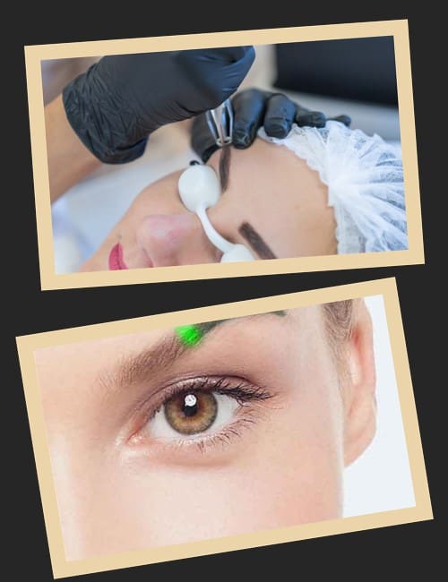 неодимовий лазер для видалення