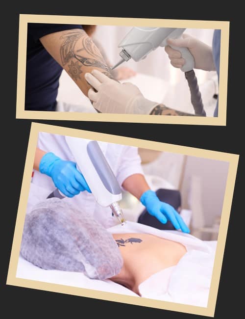 лазерного видалення татуювань