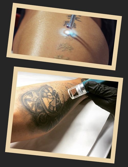 Видалення тату лазером ціна в Києві