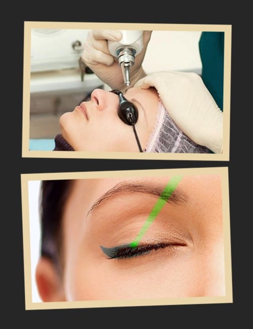 Переваги застосування лазера для видалення татуажу