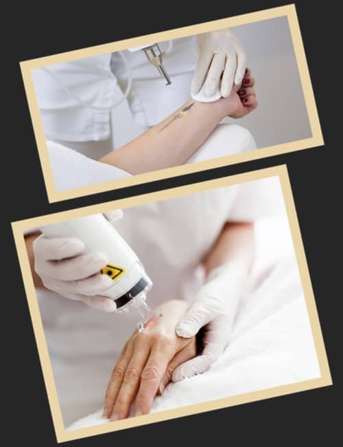 Протипоказання для видалення тату лазером