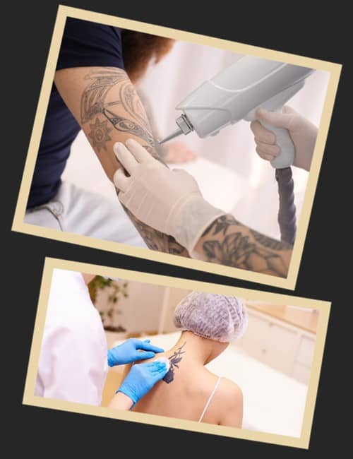 видалення тату лазером ціна за процедуру