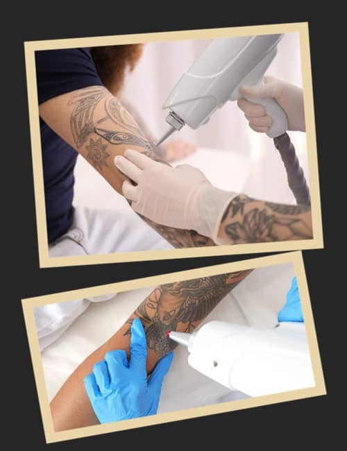 Вартість лазерного виведення тату