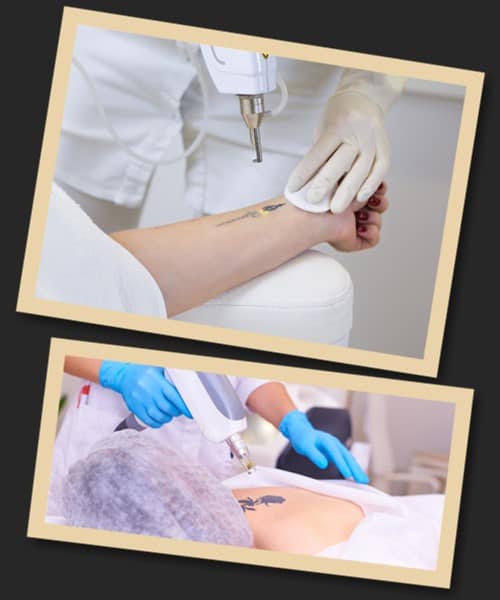 ефективність видалення татуювання