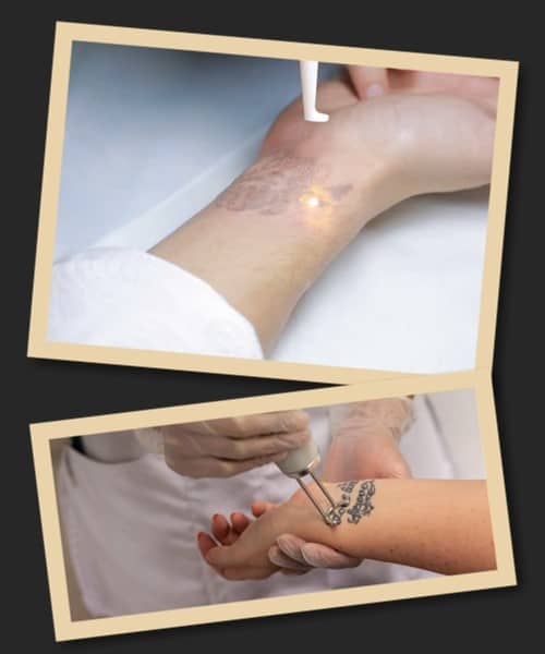 як видаляються татуювання лазером