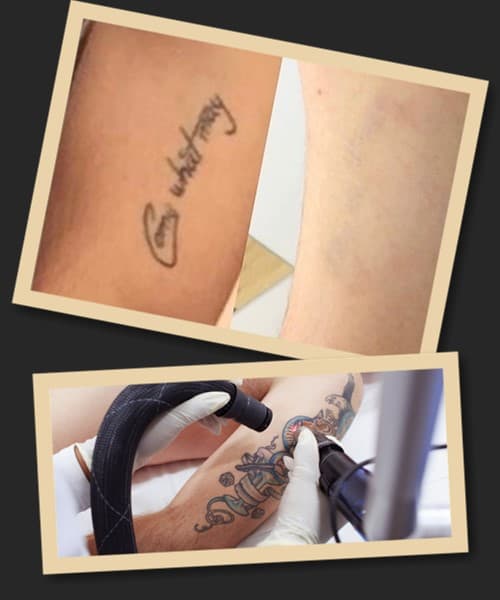 протиповказання до видалення тату