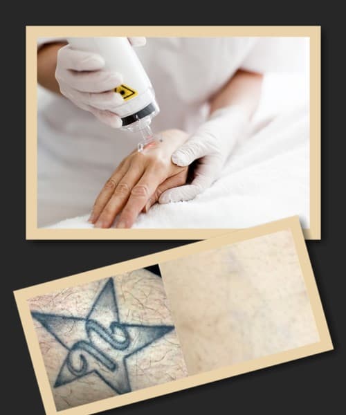 Лазерне видалення татуювань