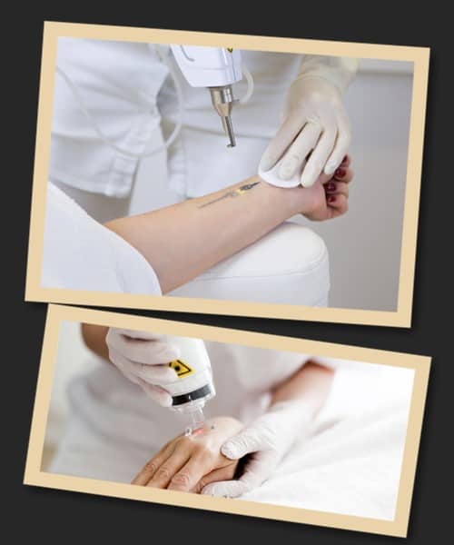 Прибрати тату за сеанс неможливо