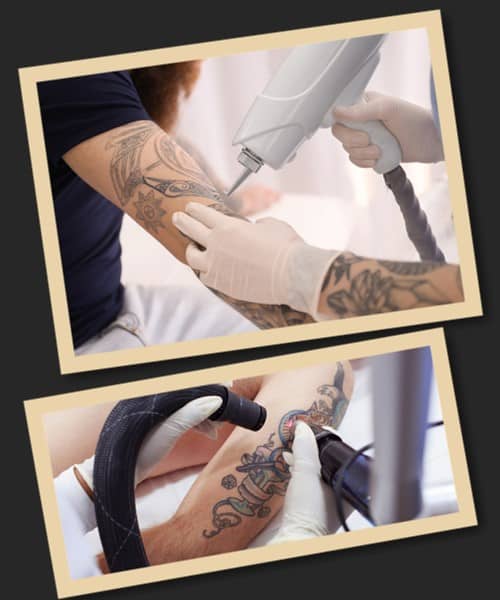 Шрами після видалення тату можуть з'явитися