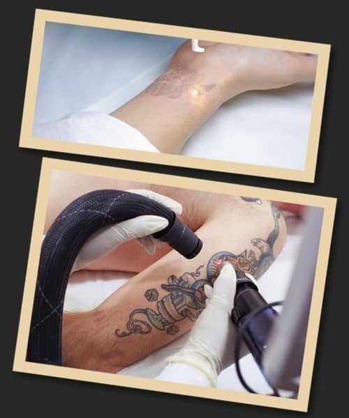 Видалення тату лазером