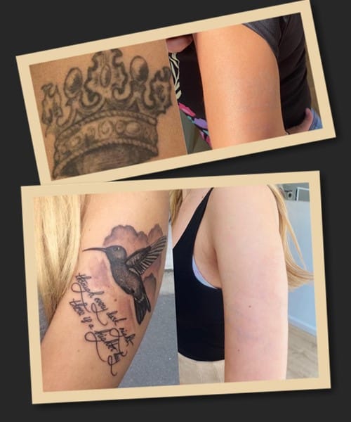 Переваги виведення татуювань лазером