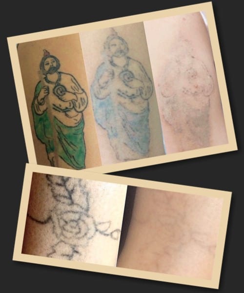 Способи зведення татуювань