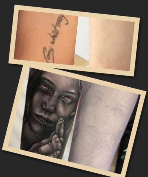 Хімічний метод видалення татуювань