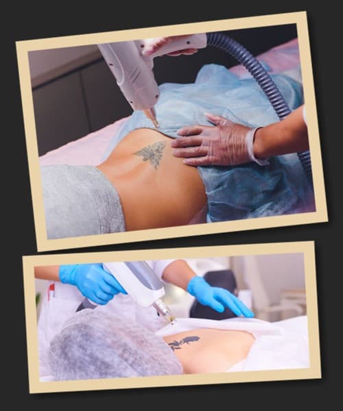 Для виведення тату використовується кілька видів лазерів