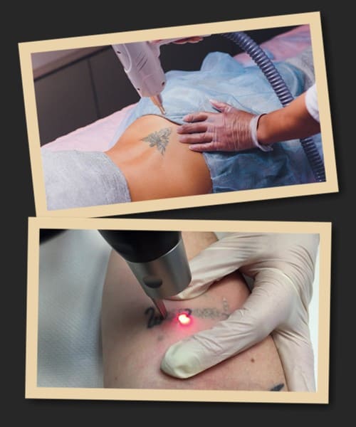 Які методи виведення тату існують