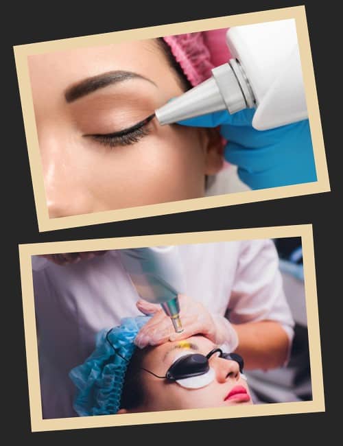 Видалення татуажу неодимовим лазером